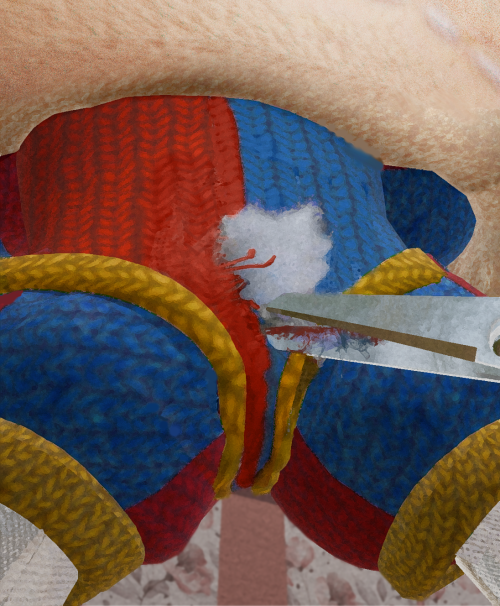 a hole with stuffing spilling out